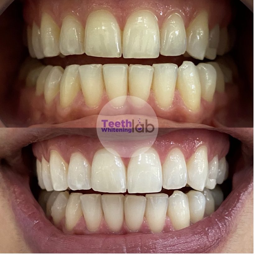 Before and after whitening result