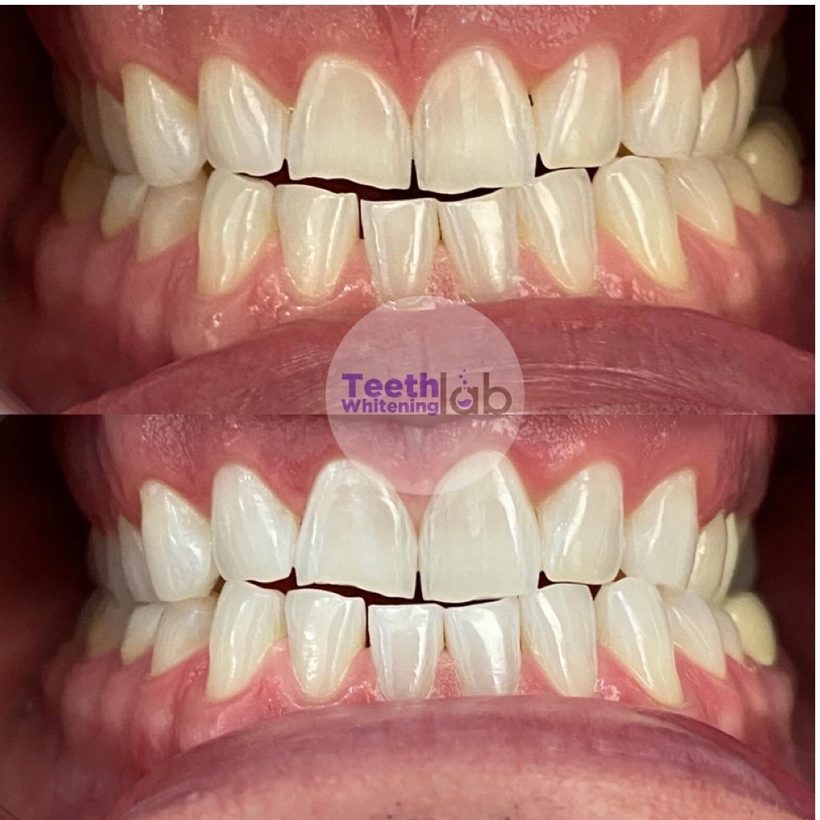 Before and after whitening result