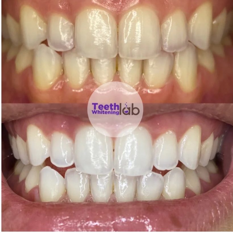 Before and after whitening result