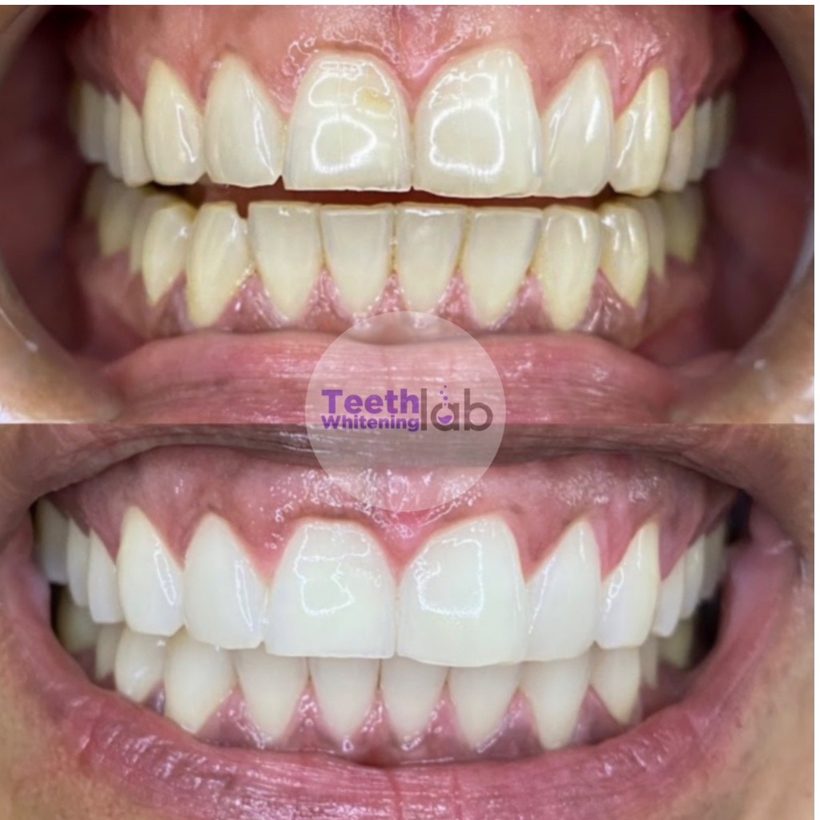 Before and after whitening result