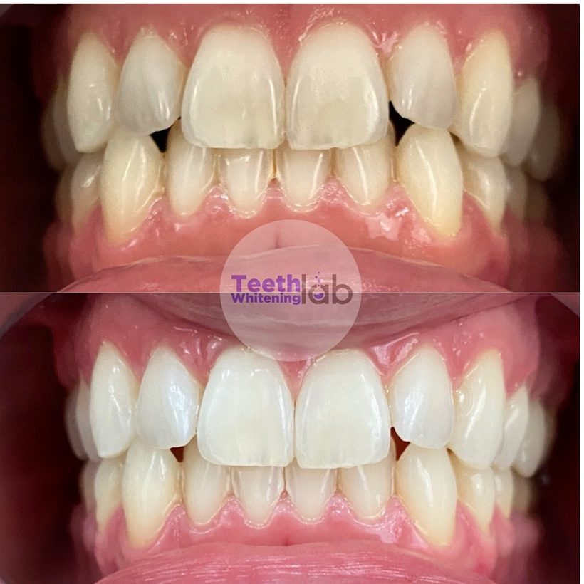 Before and after whitening result
