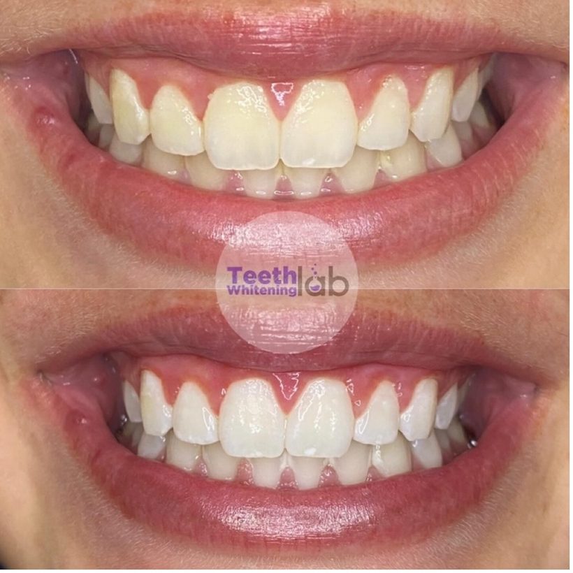 Before and after whitening result