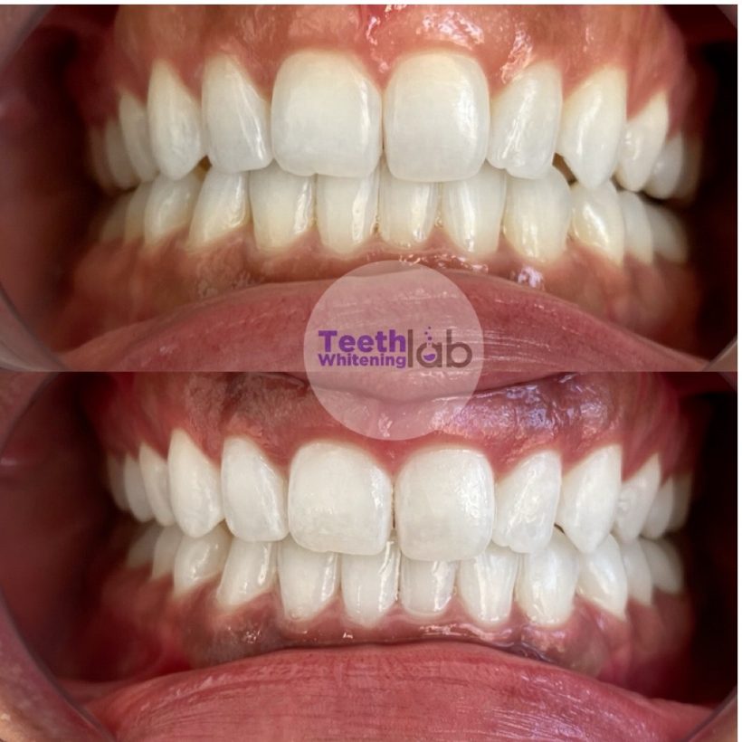 Before and after whitening result