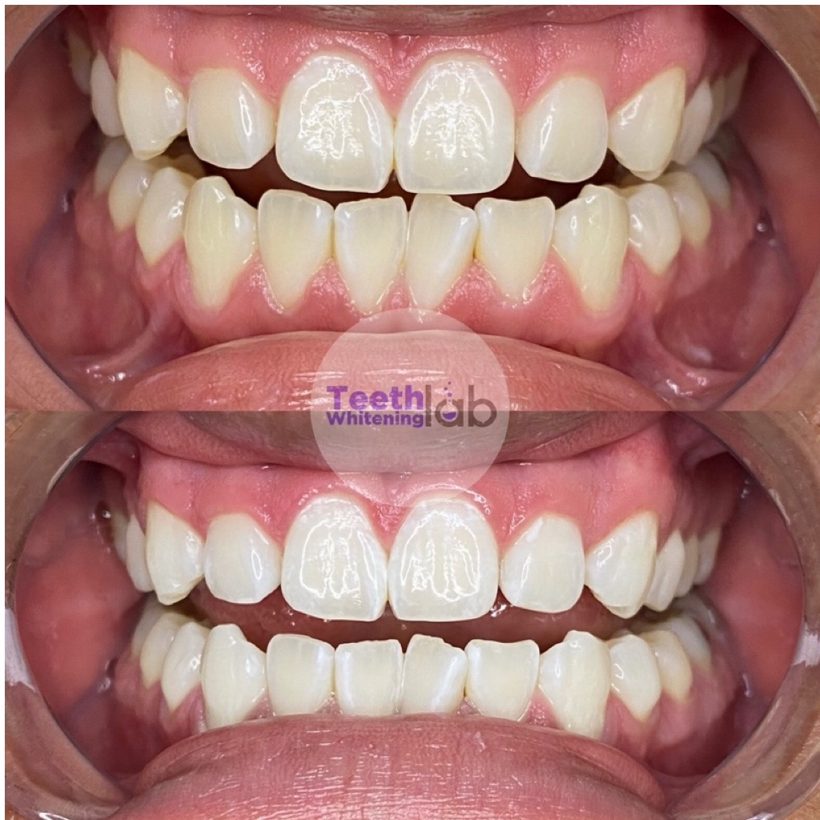Before and after whitening result