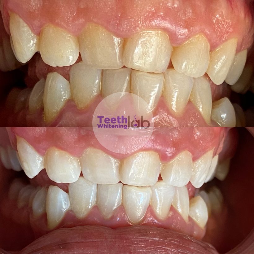 Before and after whitening result