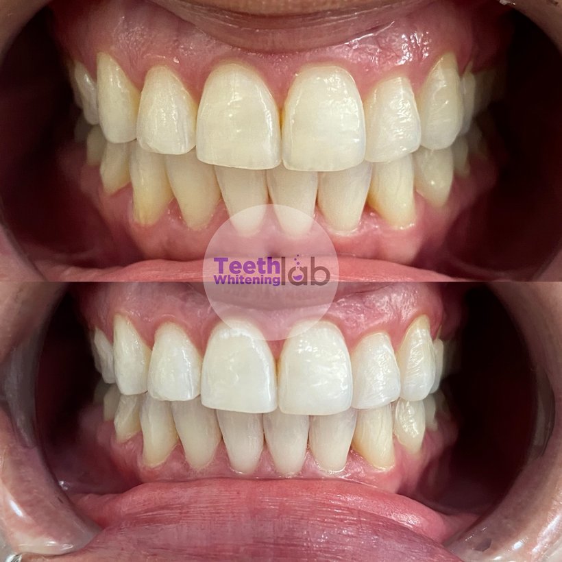 Before and after whitening result