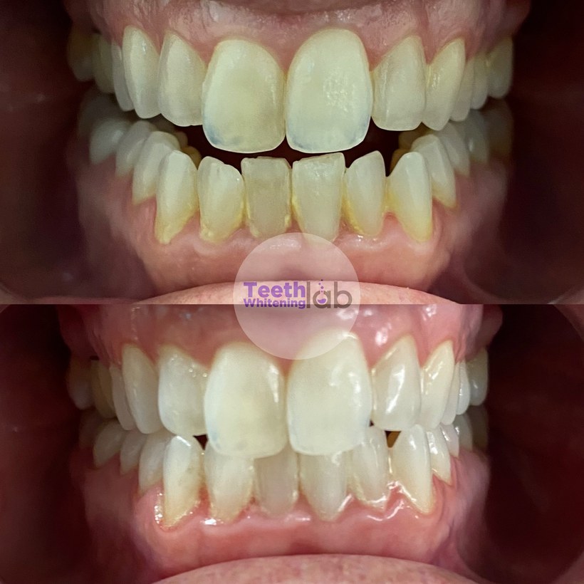 Before and after whitening result