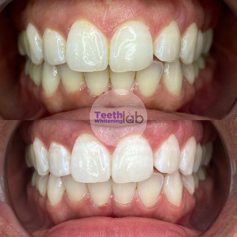 Before and after whitening result