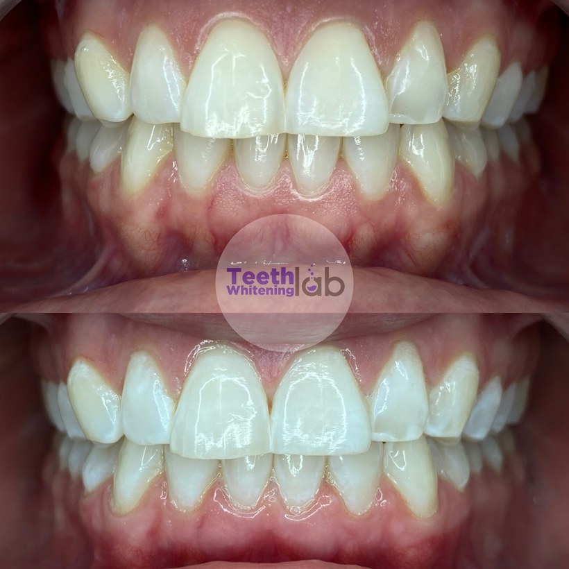 Before and after whitening result