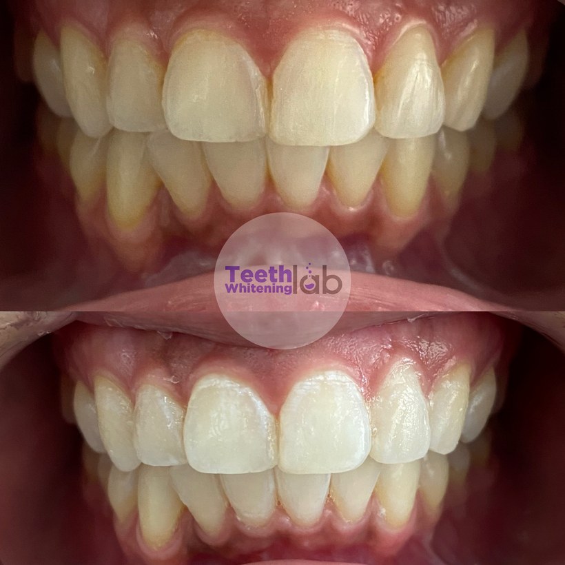 Before and after whitening result