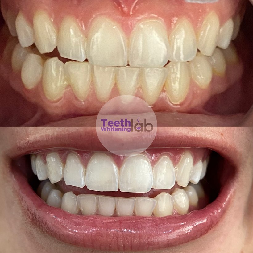 Before and after whitening result