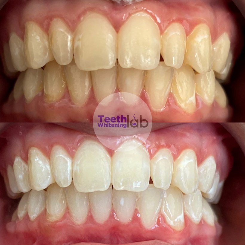 Before and after whitening result