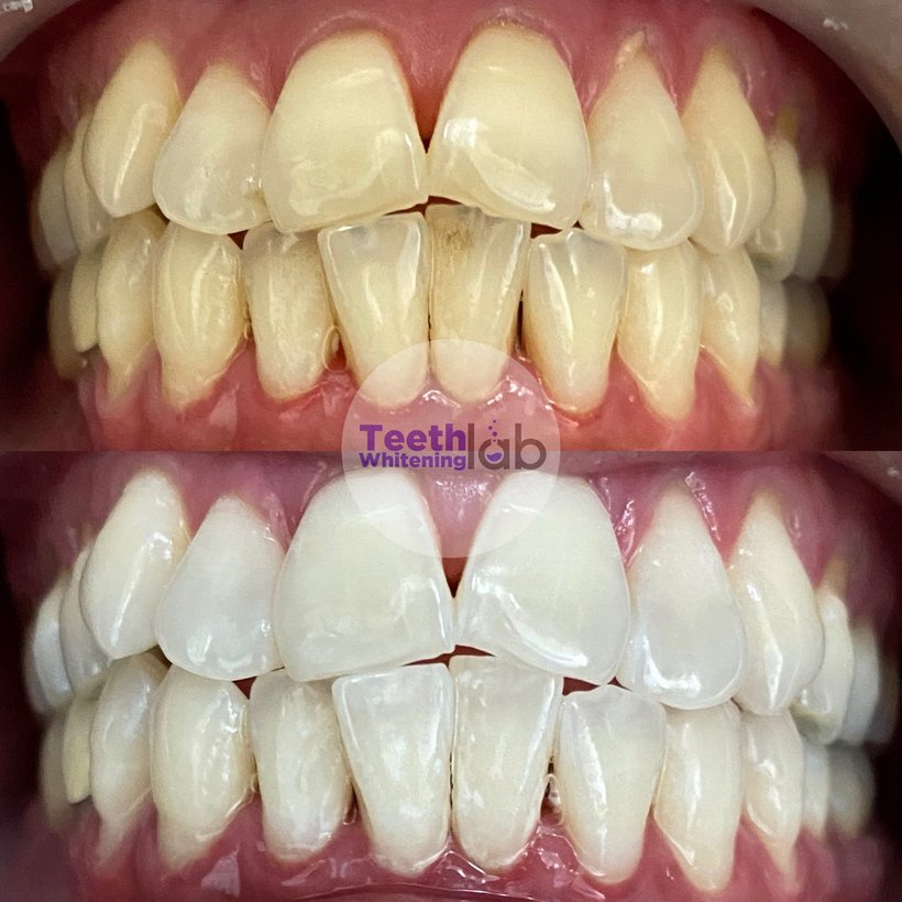 Before and after whitening result