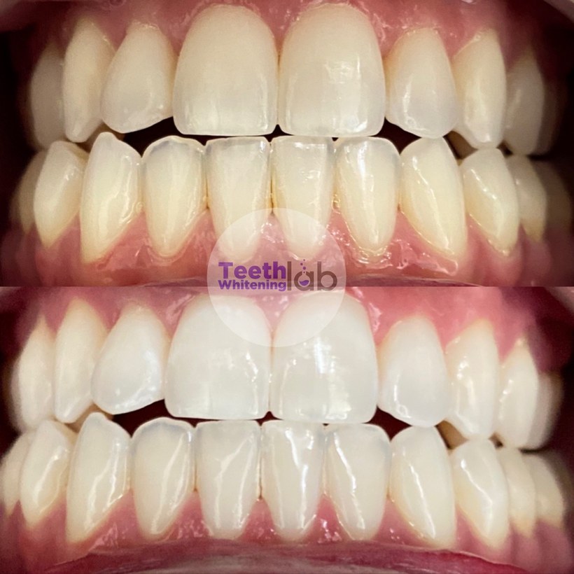 Before and after whitening result