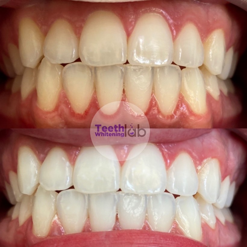 Before and after whitening result