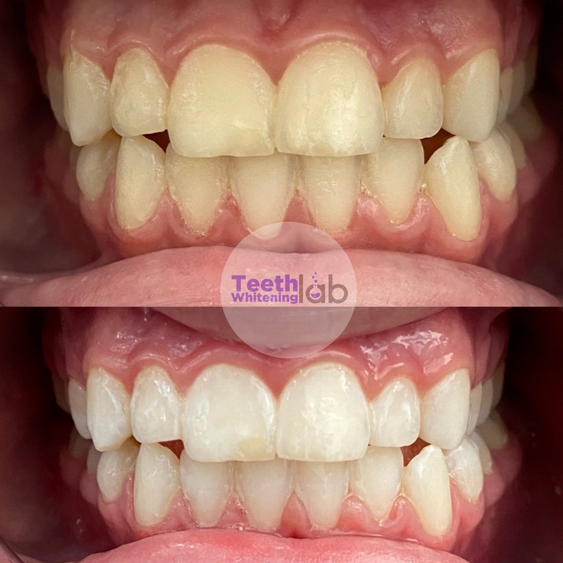 Before and after whitening result